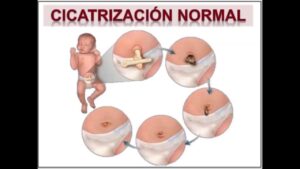 Cuánto tarda en caerse el cordón umbilical todo lo que necesitas saber