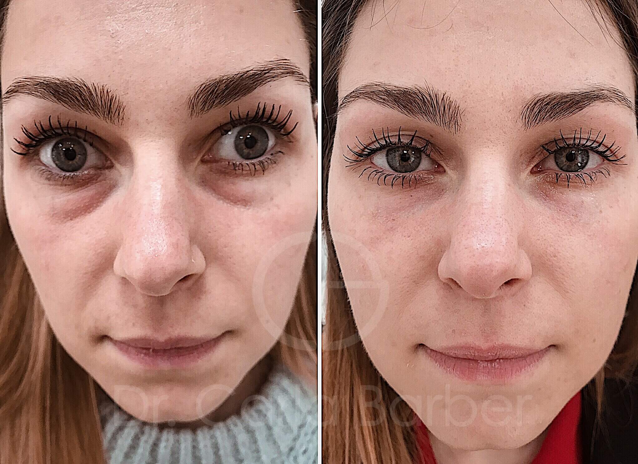 Quita Las Ojeras De Forma Natural Y Eficaz Con Cucharas: ¡Descubre El ...